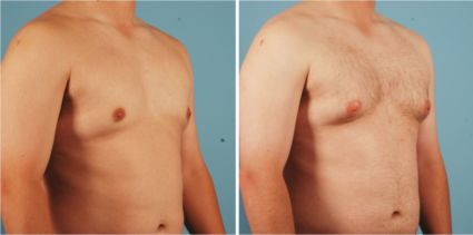 Best Place for Gynecomastia Surgery Alternative in Jersey
