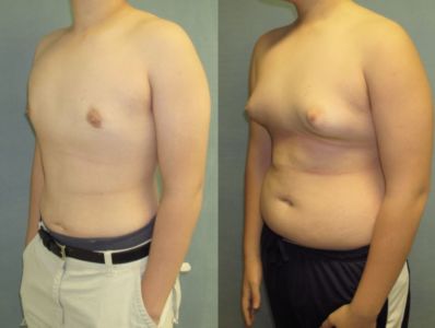Recomended Gynecomastia Surgery Alternative in Kuwait