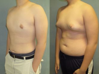 Best Place for Gynecomastia Surgery Alternative in Coral Sea Islands